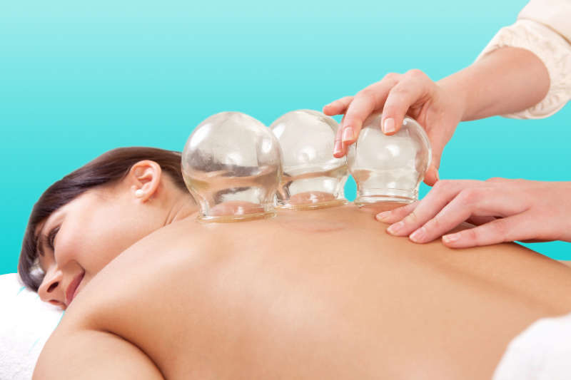 TCM Behandlung mit Schröpfgläsern am Rücken